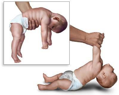 Сниженный мышечный тонус Сниженный мышечный тонус