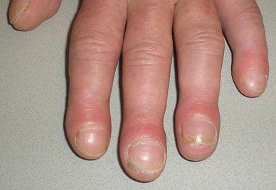 Пальцы Гиппократа [25]