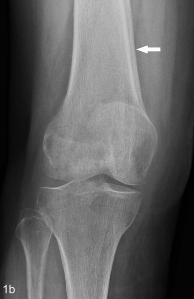 Поражение костей при ГОАП [26]