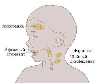 Синдром Маршалла [18]