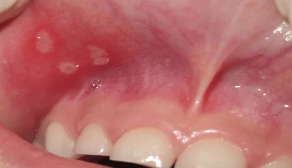 Язвы во рту при афтозном стоматите [19]