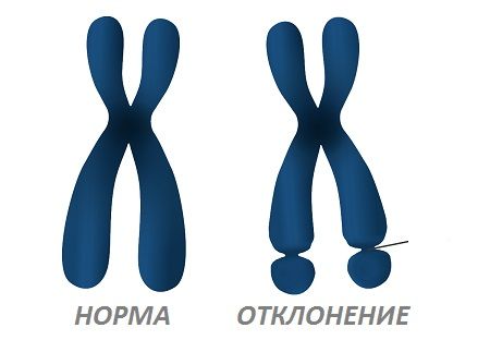 Ломкая Х-хромосома