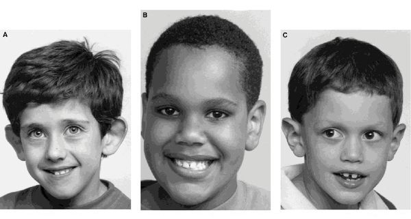 Мальчики с синдромом ломкой Х-хромосомы: от наиболее к менее выраженным внешним проявлениям болезни [20]