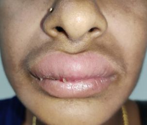 Гранулёматозный хейлит верхней губы [26]