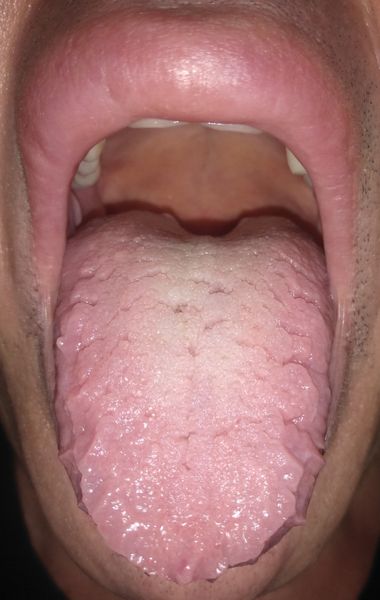 Складчатый язык и отёк верхней губы у пациента 69 лет [4]