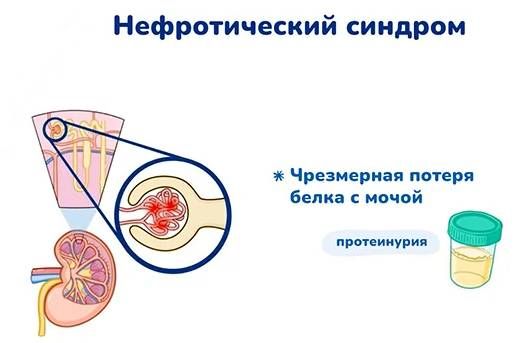 Нефротический синдром