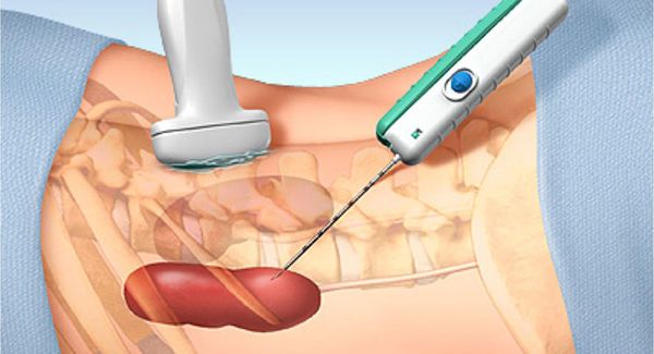 Пункционная биопсия почки