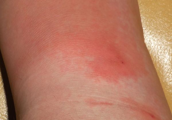 Рожеподобная эритема [18]