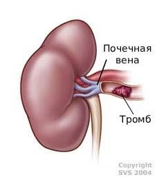 Тромбоз почечной вены