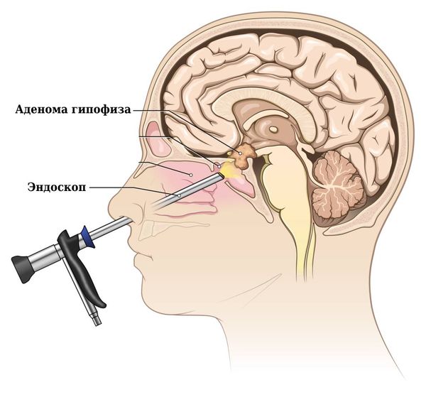 Транссфеноидальный доступ при удалении аденомы гипофиза