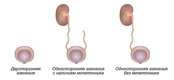 Агенезия почки