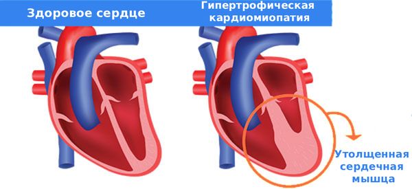 Гипертрофическая кардиомиопатия
