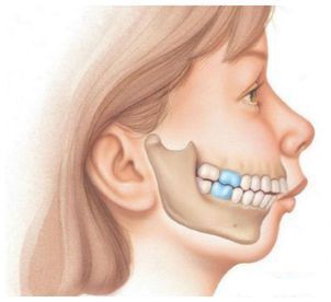 Микрогнатия нижней челюсти