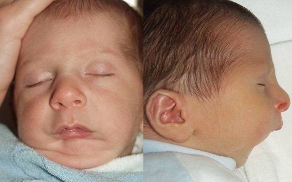 Младенец с синдромом Пьера Робена [17]