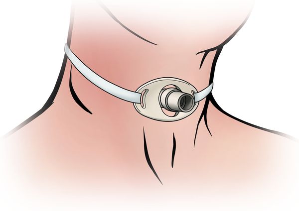 Трахеостома