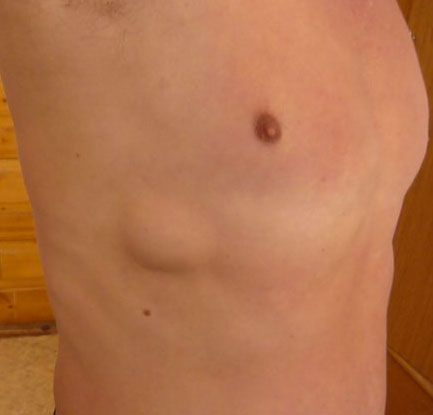 Лёгочная грыжа [25]