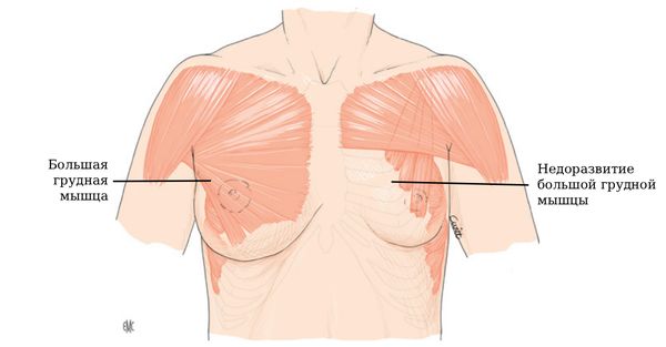 Недоразвитие большой грудной мышцы [21]