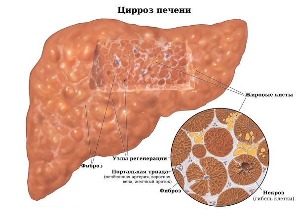 Изменения в строении печени при циррозе