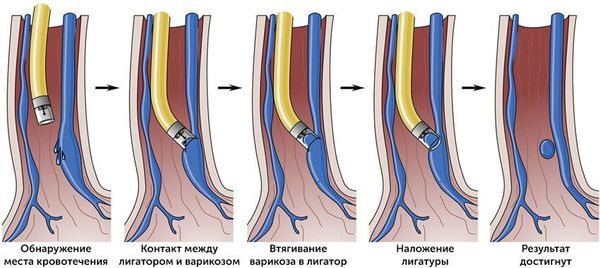 Лигирование варикозно расширенных вен пищевода