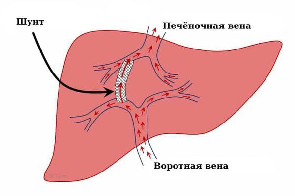 Трансъюгулярный внутрипечёночный портосистемный шунт