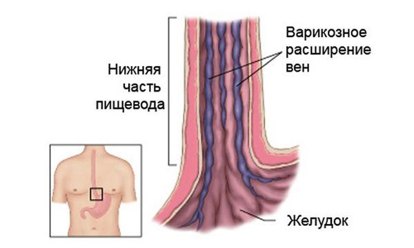 Варикозное расширение вен пищевода