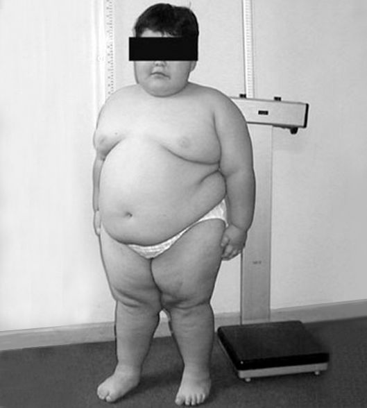 Синдром Прадера — Вилли [31]