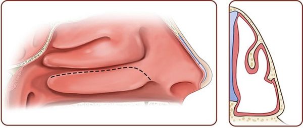 Конхотомия