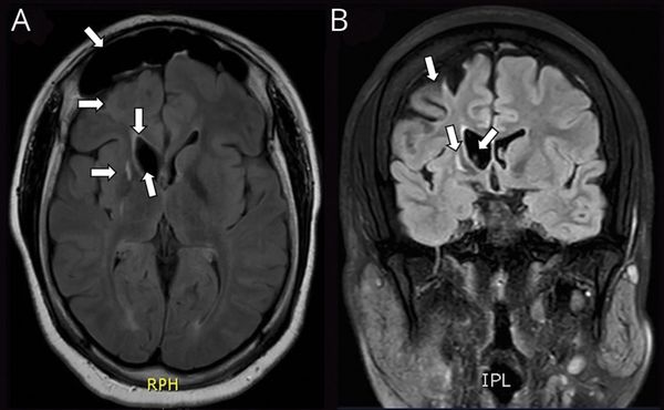 Атрофия правого полушария на МРТ [21]