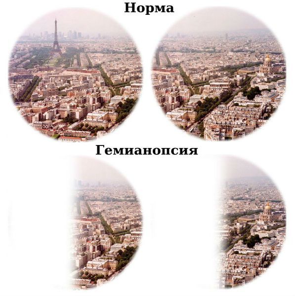 Гемианопсия