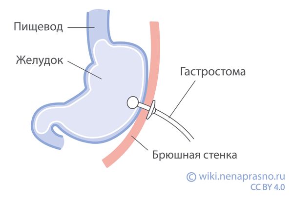 Гастростома