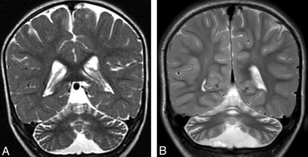 Атрофия мозжечка и коры головного мозга [25]