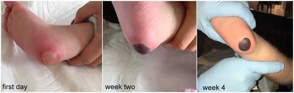 Пролежни [7]