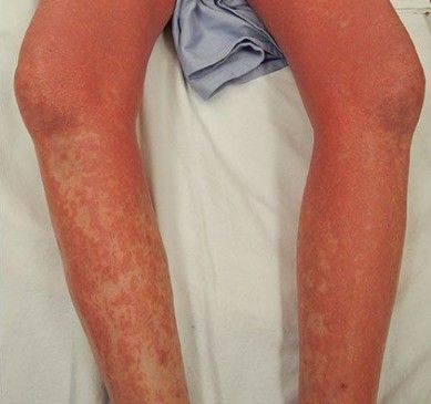 Покраснение кожи при синдроме Сезари [21]