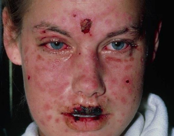 Синдром Стивенса — Джонсона [33]