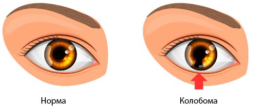 Колобома