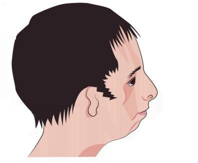 Синдром Тричера Коллинза