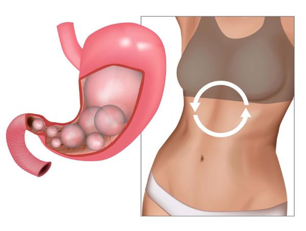 Метеоризм и вздутие Метеоризм и вздутие