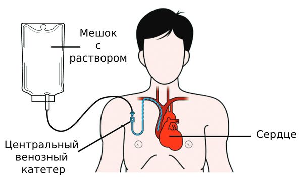 Полное парентеральное питание Полное парентеральное питание