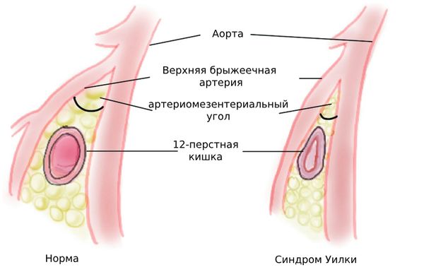 Синдром Уилки Синдром Уилки