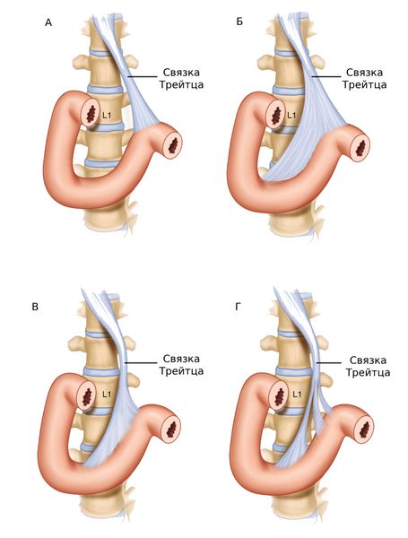 Варианты расположения связки Трейтца (чаще всего встречается вариант Б) [14]