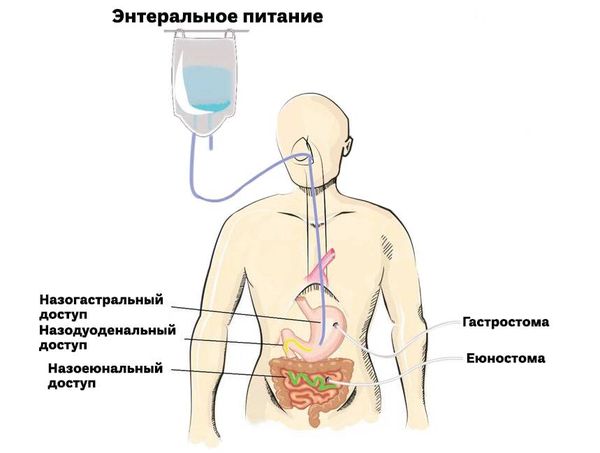 Виды зондов для энтерального питания Виды зондов для энтерального питания