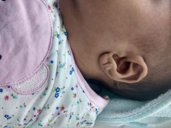 Передние складки мочки уха [17]