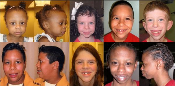 Дети с синдромом Вильямса [15]