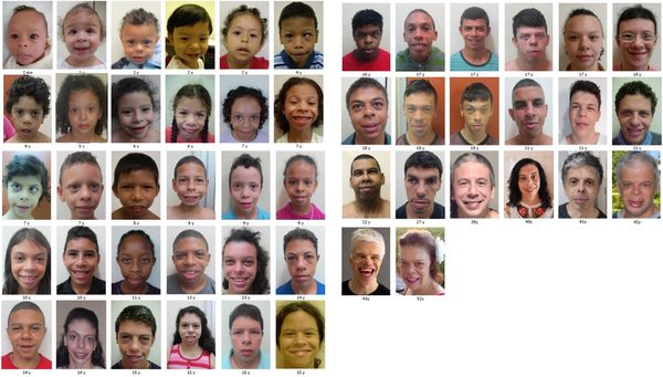 Синдром Вильямса в разном возрасте (от 2 месяцев до 52 лет) [1]