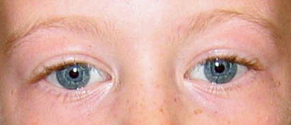 «Звёздчатый» рисунок радужной оболочки у ребёнка с синдромом Вильямса [1]