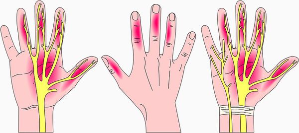 Чувствительные нарушения в пальцах при синдроме запястного канала