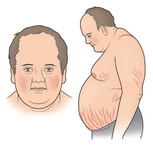 Болезнь Иценко — Кушига