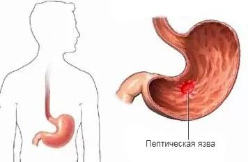 Язва в желудке при синдроме Золлингера — Эллисона