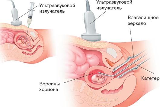 Биопсия ворсин хориона (трансабдоминальная и трансцервикальная)