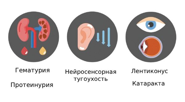 Основные проявления синдрома Альпорта